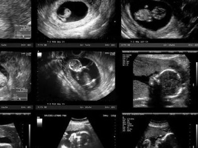 44岁做三代试管婴儿能成功吗？我分享一下！